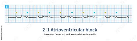 The sinus P wave marked by the yellow circle passes down the ventricle ...