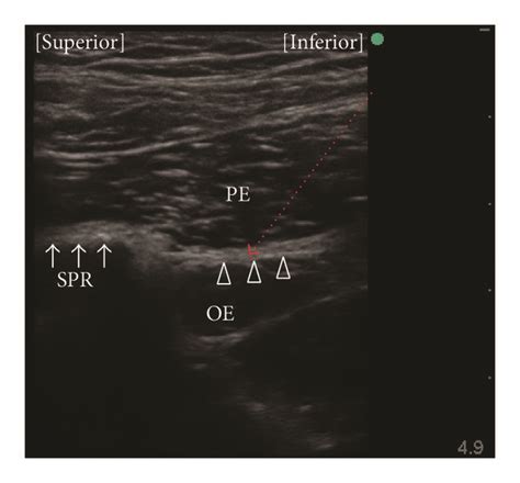 Ultrasound images obtained during obturator nerve block. (a) A ...