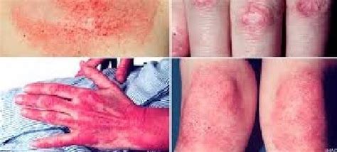 Dermatomyositis: Causes, Symptoms, Diagnose, and treatments : r/subxofficial