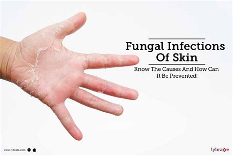 Fungal Infections Of Skin - Know The Causes And How Can It Be Prevented! | Lybrate