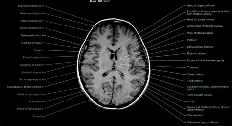 Brain MRI - NeurologyNeeds.com | Brain, Mri, Arc of the covenant