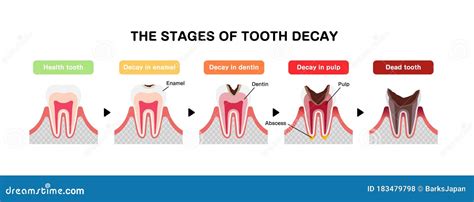 The Stages of Tooth Decay / Flat Vector Illustration Stock Vector - Illustration of dentist ...