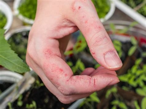 Mild Poison Ivy Rash On Hands