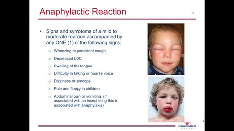 Food Allergy Anaphylaxis