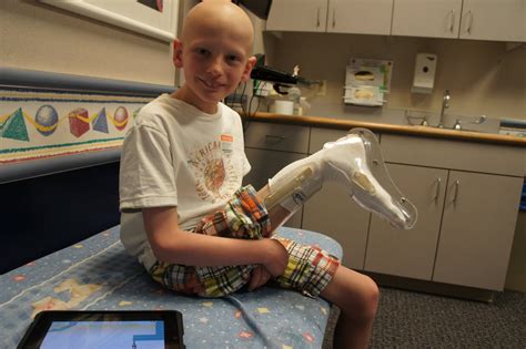 Steven Battles Cancer: Prosthetic--part 2