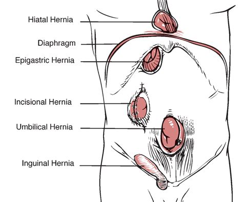 Robotic Hernia Surgery Longview - Weight Loss Longview