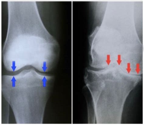 Arthritis of the Knee - Clinica Gran Alacant