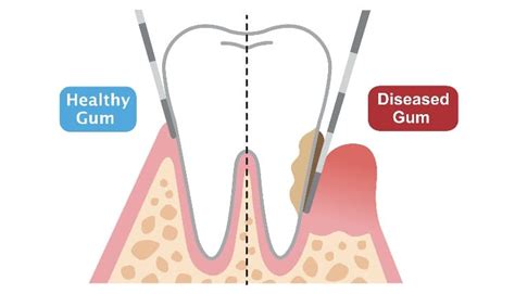 Tips on Periodontal Probing