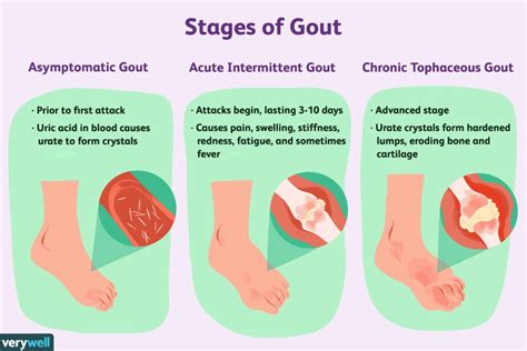 Gout - Symptoms, Causes, Types & Treatment - Santripty