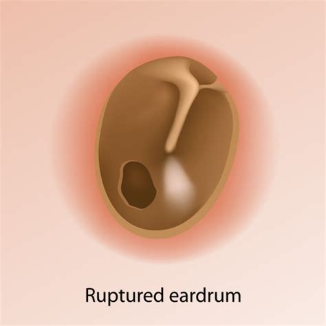 Tympanic Membrane Perforation | ENT Kerimis Clinic Ears,Nose, and Throat in Limassol Cyprus