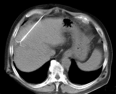 Radiofrequency Ablation of Liver Tumor