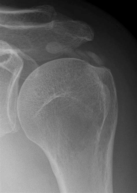 Calcific tendinitis of the rotator cuff associated with intraosseous loculation: Two case ...