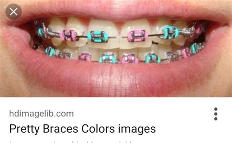 Really pretty blue and pink braces:) | Cute braces, Braces colors, Pink ...