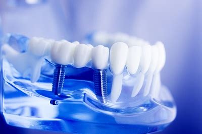 Dental Implants in Houston, TX | Partial Dentures | Crowns