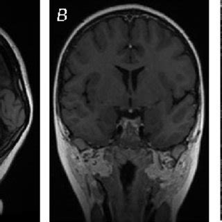 (PDF) Short Stature due to Ectopic Neurohypophysis: Case Report