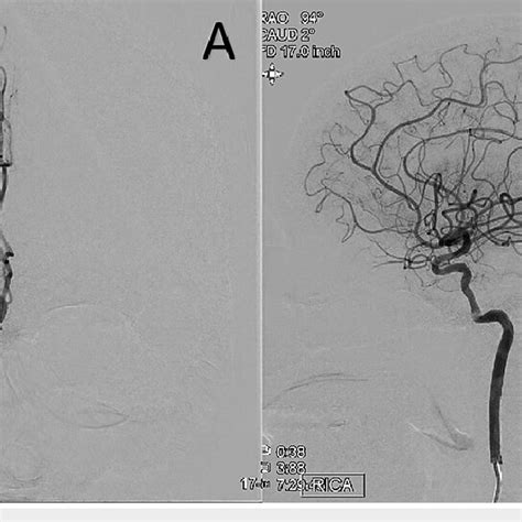 Right internal carotid artery angiogram, AP view (A) and lateral view ...