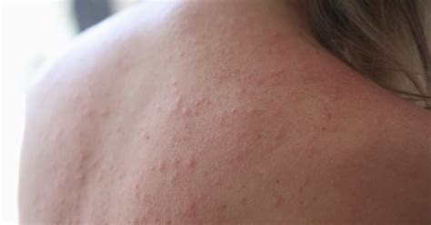 Heat rash (prickly heat): common symptoms and causes