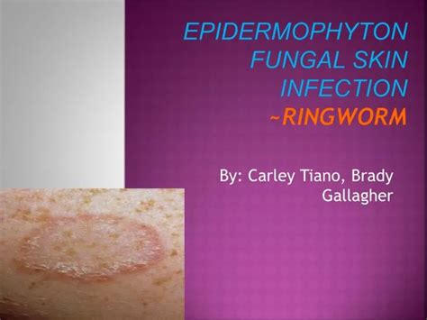 PPT - Epidermophyton fungal skin iNfection ~RINGWORM PowerPoint Presentation - ID:1847962