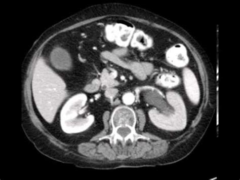 Delayed Nephrogram Stone CASE DISCUSSION by a Radiologist - YouTube