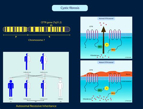 Cystic fibrosis: MedlinePlus Genetics