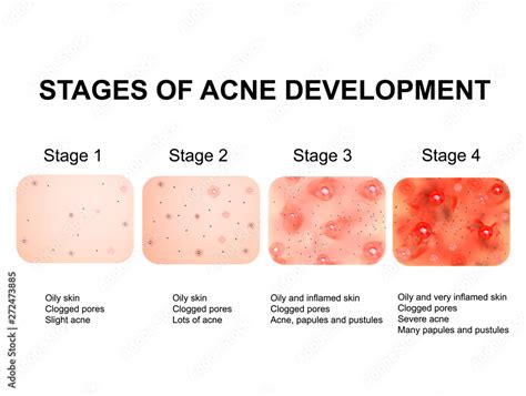 Stages of development of acne. Inflamed skin with scars, acne and pimples. The texture of ...