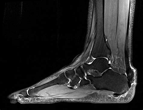 Achilles Tendon Xanthoma