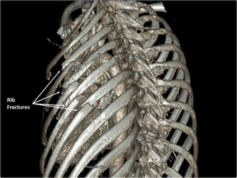 3D reconstruction of CT chest showing severely displaced fractures of ...