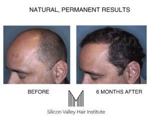 There Are Many Factors Which Affect the Success Rate of Hair Transplants - Miguel Canales M.D.