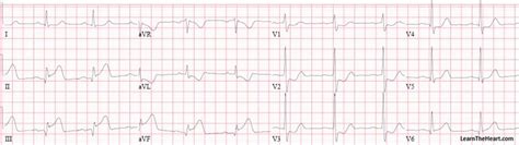 Posterior Wall Myocardial Infarction (MI) ECG Review | Learn the Heart