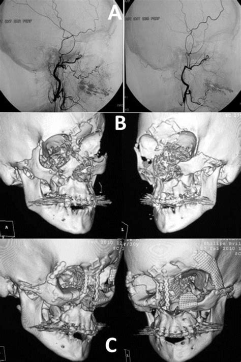 An impressive case of complete traumatic maxillofacial degloving | Pocket Dentistry