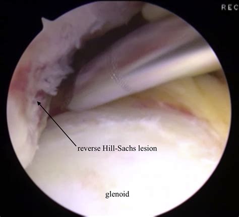 Arthroscopic Transfer of the Subscapularis Tendon for Treatment of a Reverse Hill-Sachs Lesion ...