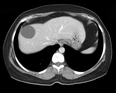 Simple hepatic cyst | Radiology Reference Article | Radiopaedia.org