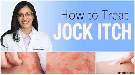 JOCK ITCH: CAUSES,SYMPTOMS, ANDTREATMENTS