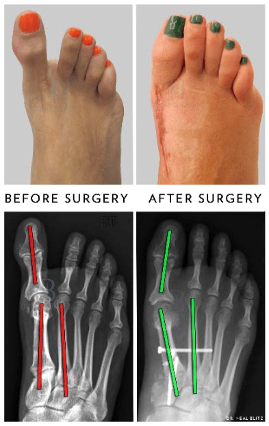 Difference Between Hallux Varus And Hallux Valgus - Almawi Limited The ...