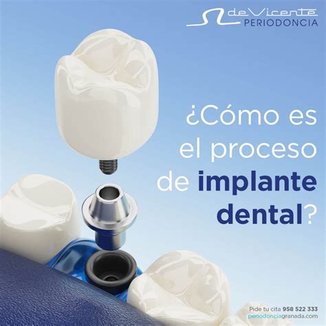 ¿Cómo es el proceso de implante dental? - Clínica Dental De Vicente Ortodoncia - Periodoncia ...