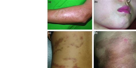 localized scleroderma – Liberal Dictionary