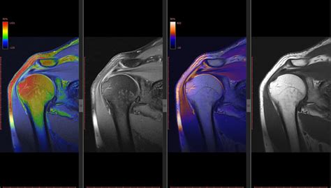 What is a Shoulder MRI arthrogram?