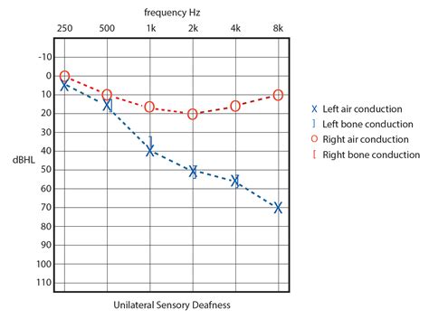 Bilateral Sensorineural Hearing Loss