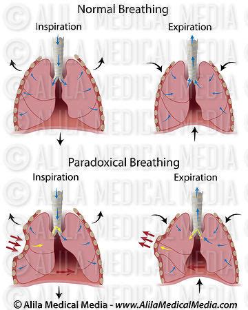 Alila Medical Media | Paradoxical breathing. | Medical illustration