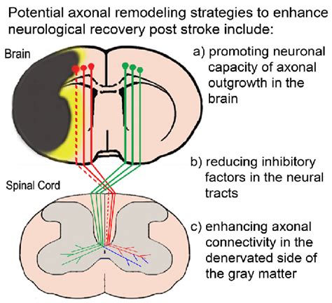 A diagram showing corticospinal tract (CST) axonal degeneration and ...