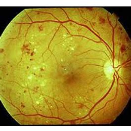 Diabetic Retinopathy | Eyes of The Southwest