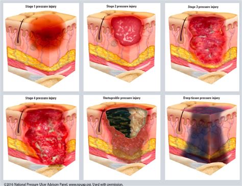 Pressure Injuries | Cardiac Health