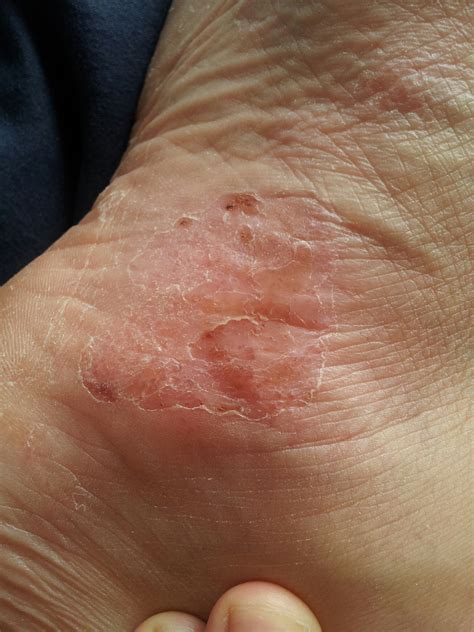 Pompholyx - an extreme eczema of the hands or feet