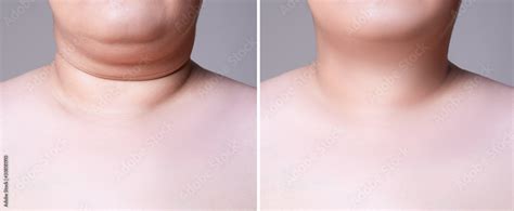 Skin rejuvenation on the neck, before after anti aging concept, wrinkle treatment, facelift and ...