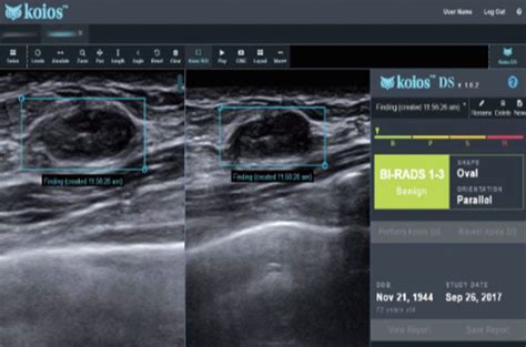 Breast Cancer Diagnosis using AI in Ultrasound