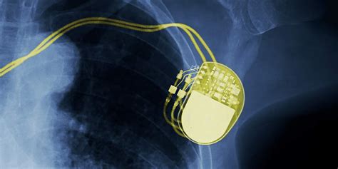 MRI With Pacemaker: Is It Safe? - American Health Imaging