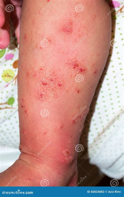 scabies lesions - pictures, photos