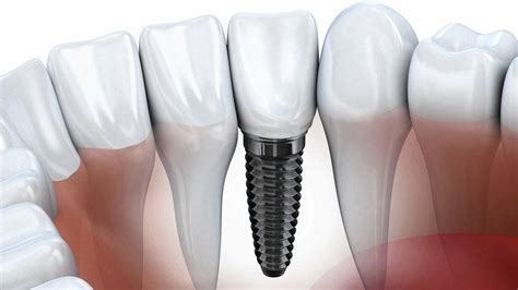 How To Use The X-Rays In Dental Implant Identification? | by Vita ...