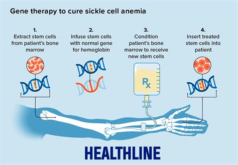 Casgevy Therapy - A Gene Therapy For Sickle Cell Disease - PWOnlyIAS