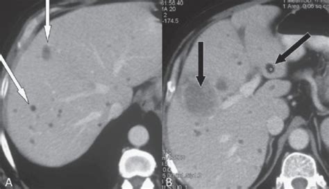 Axial contrast-enhanced CT scans show multiple, hypoden | Open-i